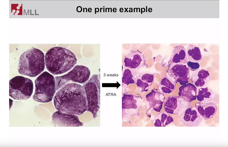 Image of Hematologic Disorder